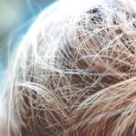 Haartransplantatie in Istanbul: De oplossing voor je haarproblemen